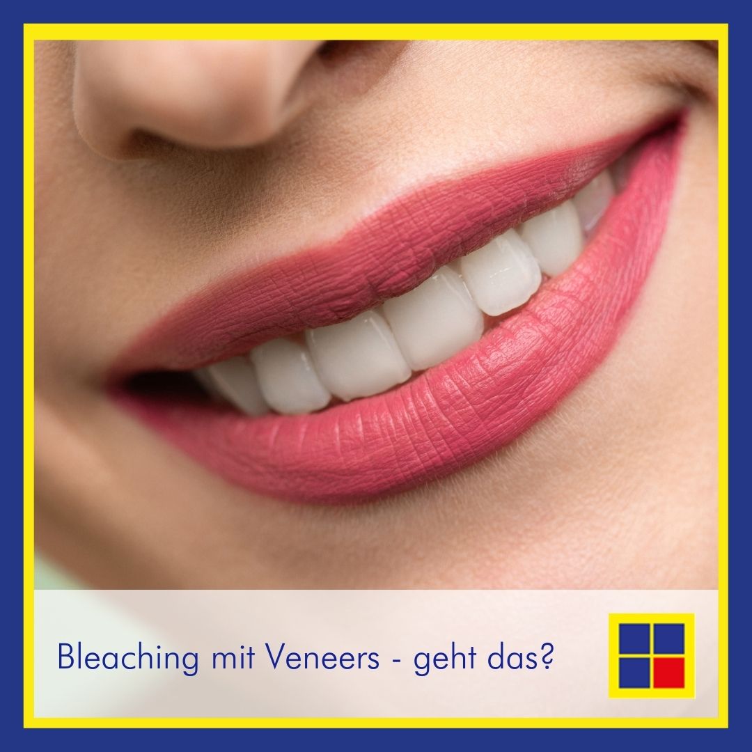 Bleaching mit Veneers geht das? Aktuelles Item Zahnarzt Ansbach