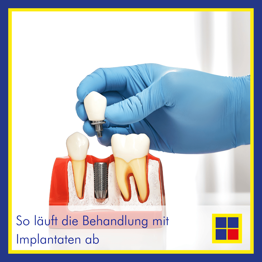 19 5 2025 DIE EINZELNEN BEHANDLUNGSSCHRITTE BEI EINEM ZAHNIMPLANTAT visual data 6