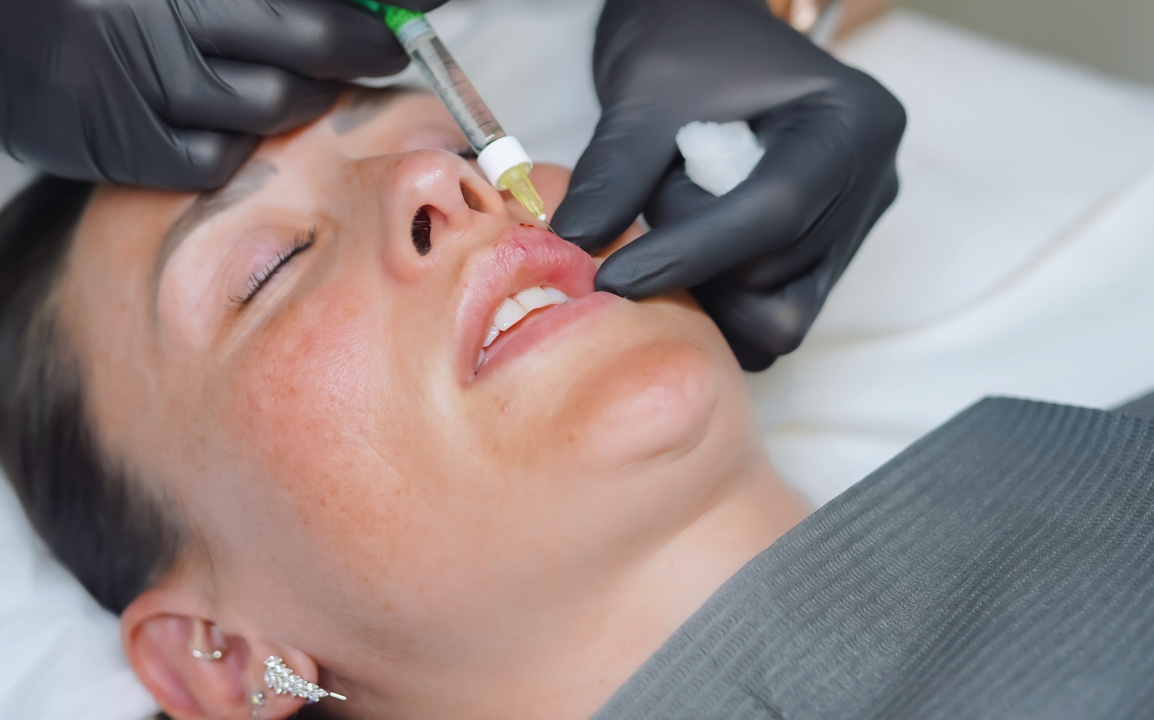 dermal fillers
