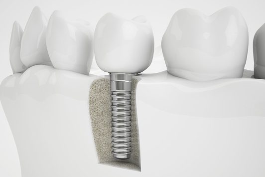 Zahnimplantat Zahnarzt Aal Wipperfürth Dentaal